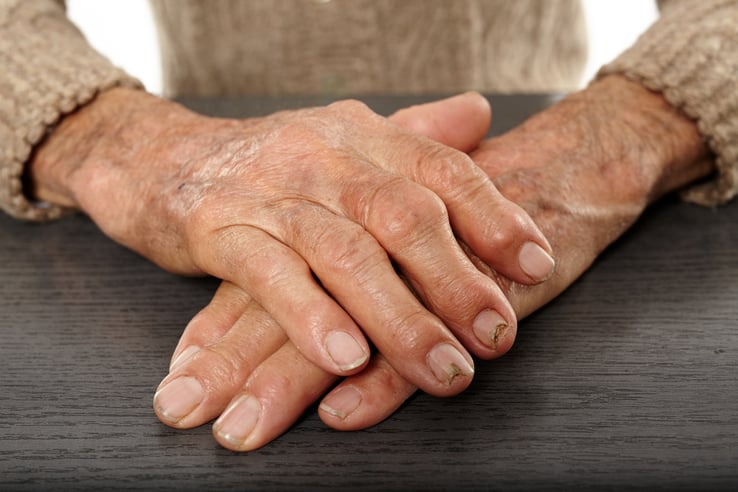 Rheumatoid Arthritis? How You Can Stop It From Slowing You Down
